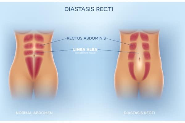What Non-Surgical Options Are Available for Diastasis Recti Barnet?