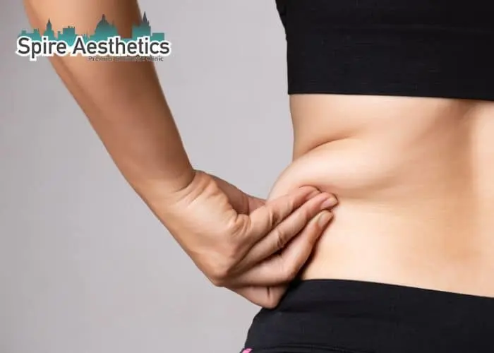 Image of woman pinching fat on their hips Barnet. Fat Freezing treatment