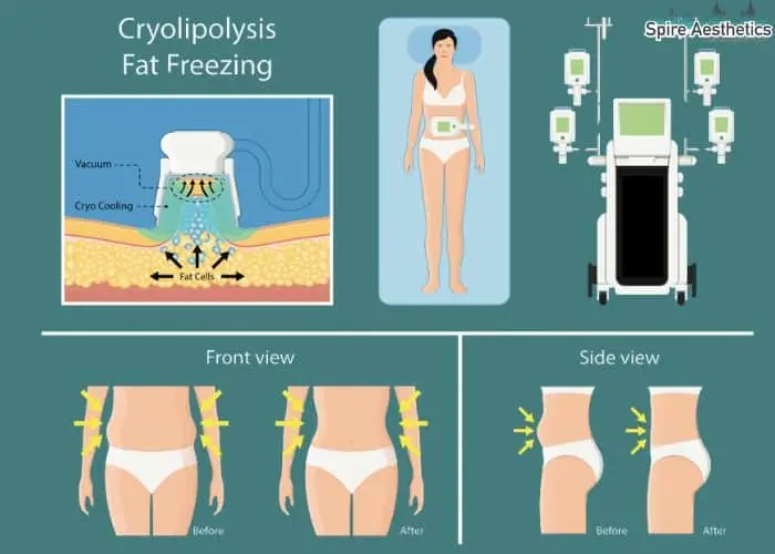 Fat freezing treatment Barnet benefits for competitions to remove stubborn fat deposits.