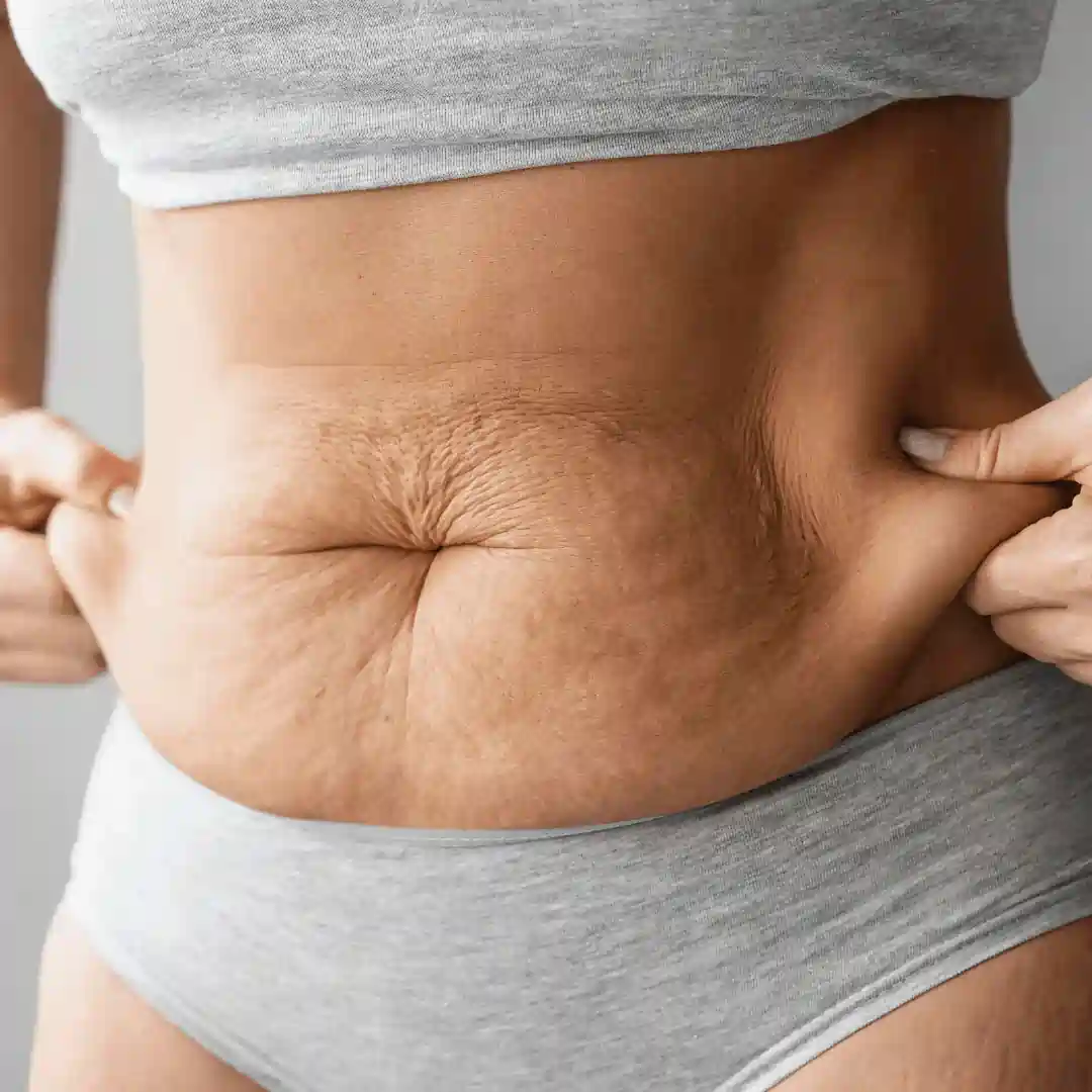 Is It Normal to Have Loose Skin After Pregnancy Barnet?