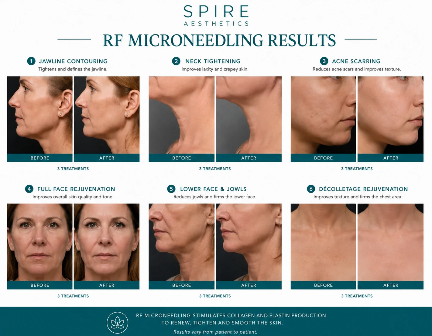 RF Microneedling Skin tightening Barnet results