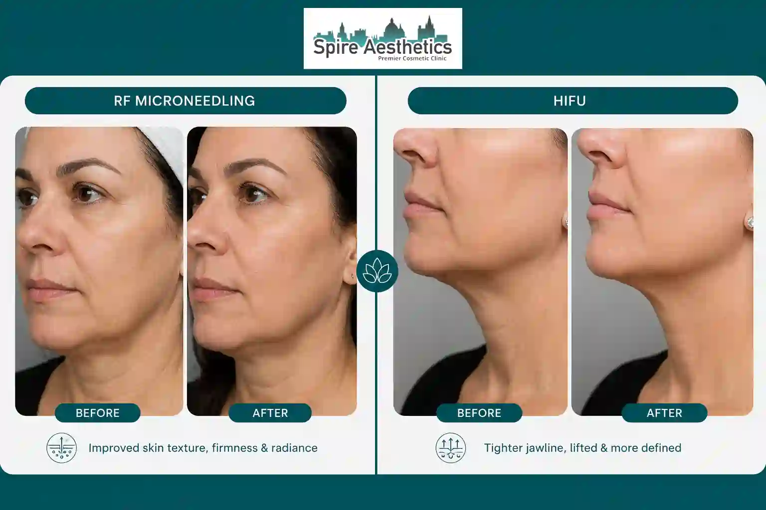 Can RF Microneedling and HIFU Be Combined Barnet?