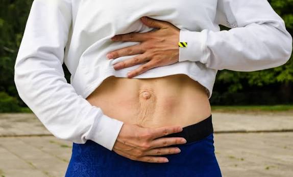 When Could Diastasis Recti Be the Missing Piece of the Puzzle Barnet?
