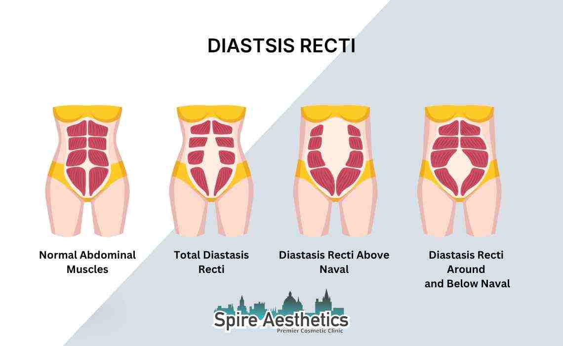 Is Non-Surgical Diastasis Recti Treatment Right for You? Common Concerns Answered Barnet